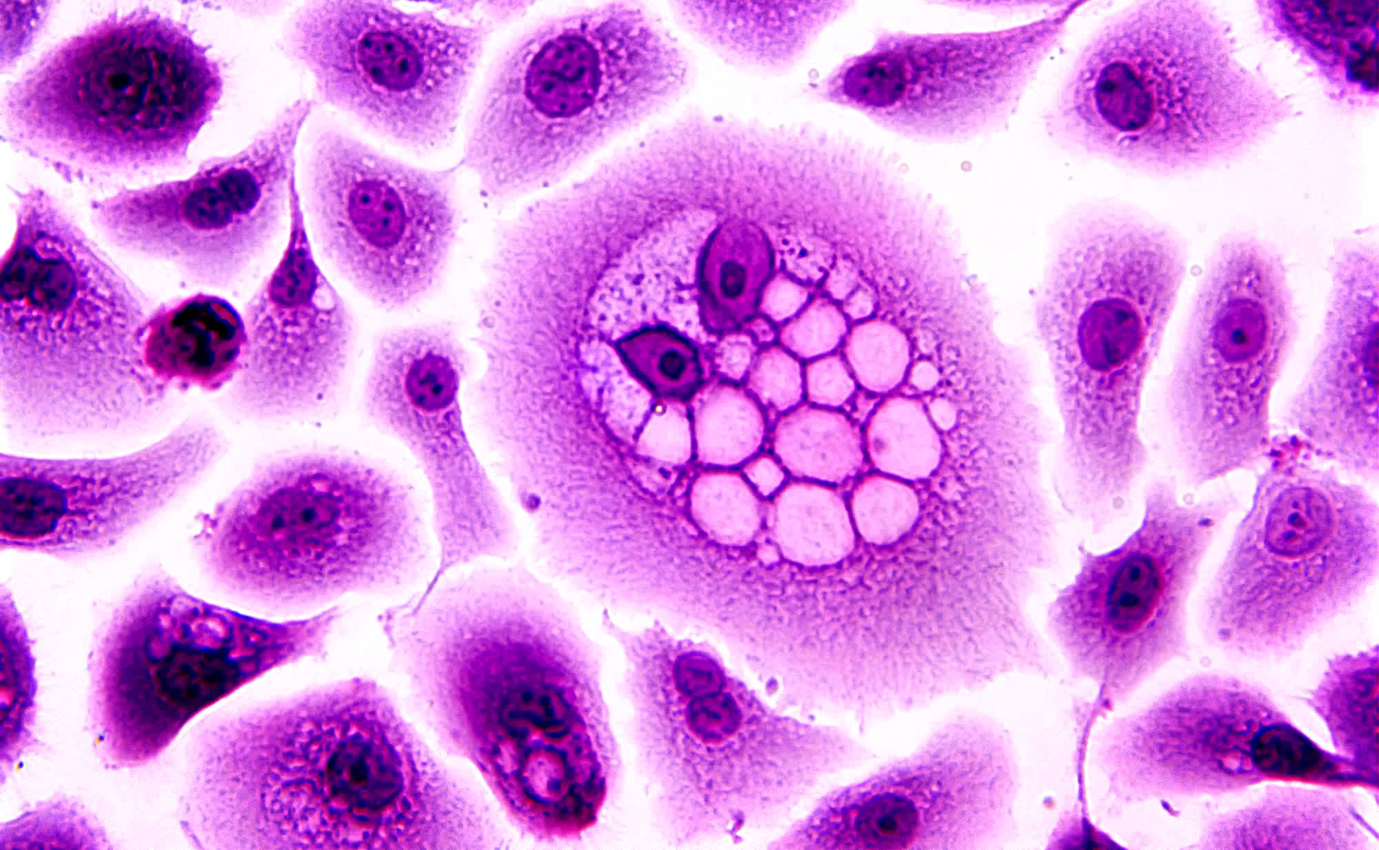 Researchers use genetically engineered immune cells to put a child